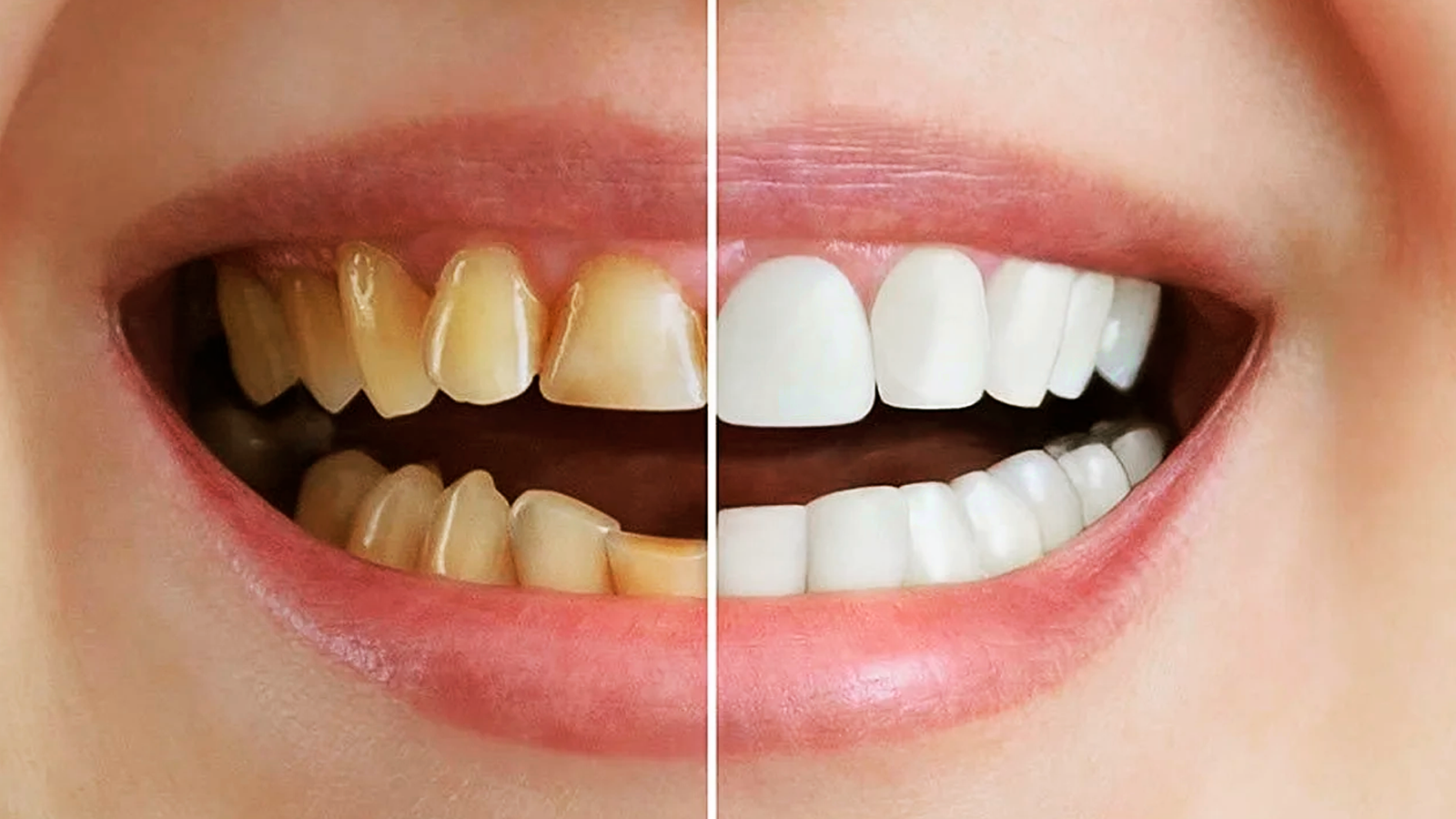 A Chave para um Sorriso Perfeito de Celebridade